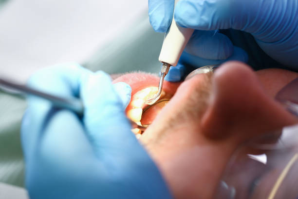 Best Emergency Treatment for Dental Infections or Abscesses in Sullivans Island, SC